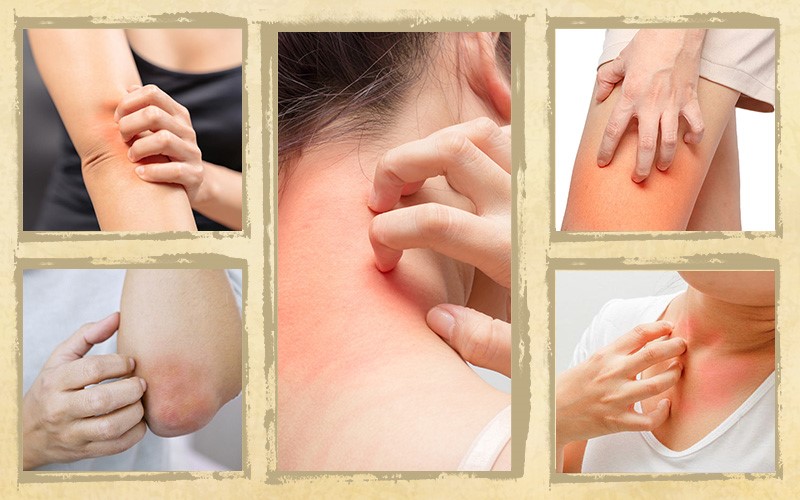 Cách trị nổi mẩn ngứa tại nhà