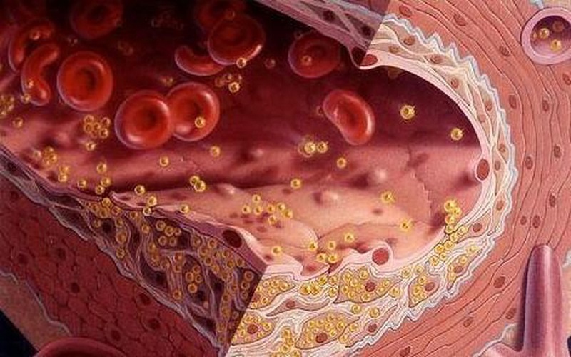 Chỉ số mỡ máu bao nhiêu là bình thường