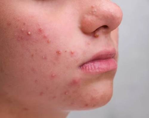 Uống gì để trị mụn nội tiết?