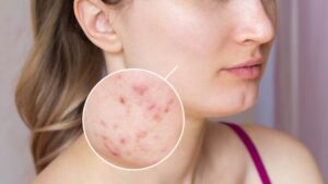 Thuốc giải độc gan trị mụn tốt nhất