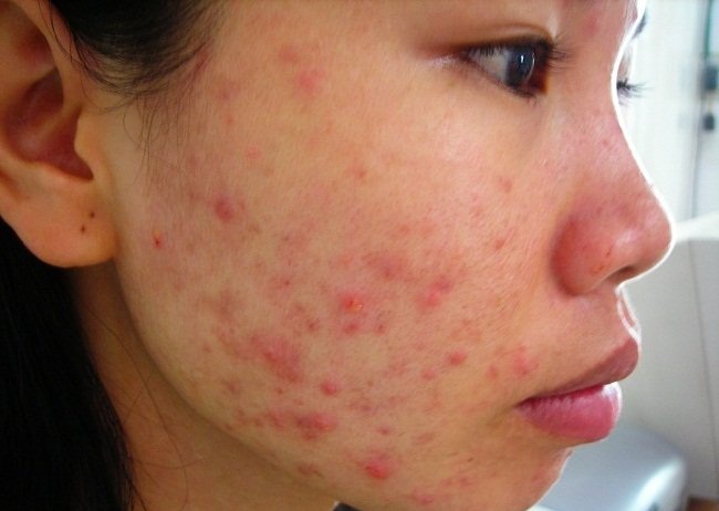 Nóng gan nổi mụn nên uống gì?