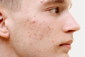 Nóng trong người nổi mụn nên uống thuốc gì?