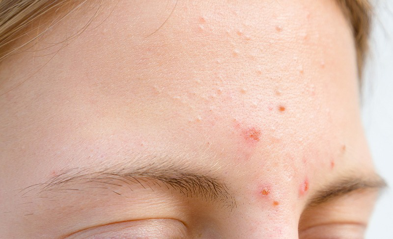 Uống thải độc gan có hết mụn không?