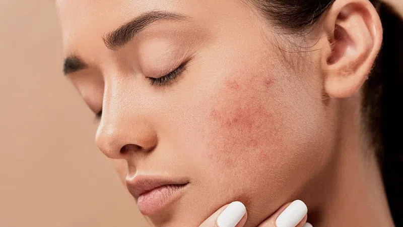 uống thuốc giải độc gan trị mụn