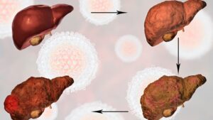 Gan yếu có nguy hiểm không là thắc mắc phổ biến